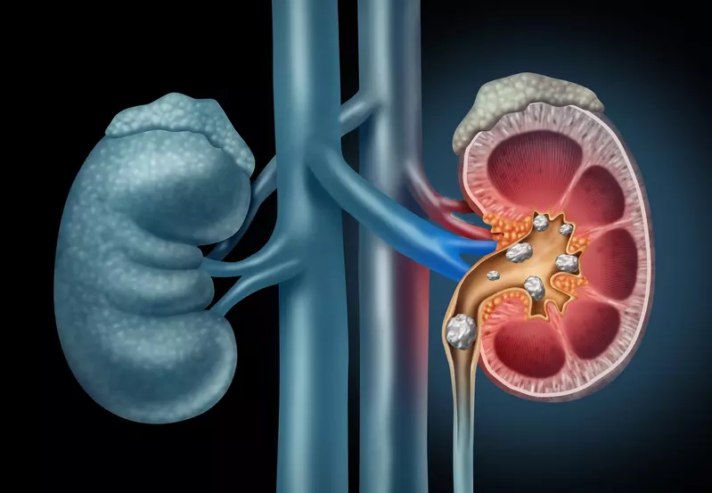 Digital image of what kidney stones can look like inside the body ( a urologist's view)