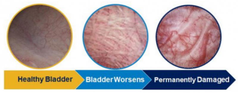 urolift-image1