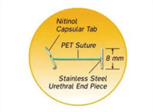 urolift-image2